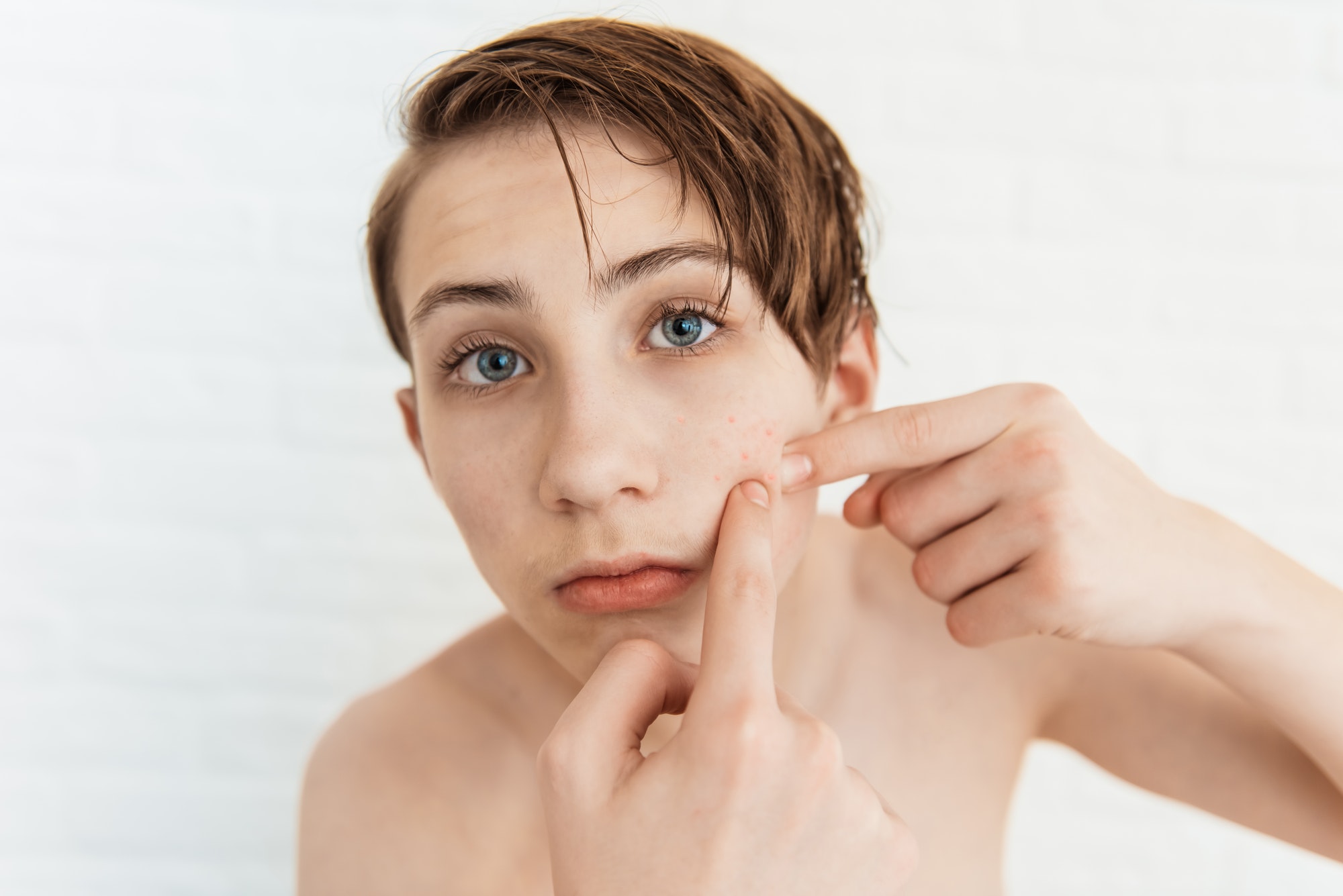 Teen boy with red pimples on on his face, closeup. Acne and skin problem